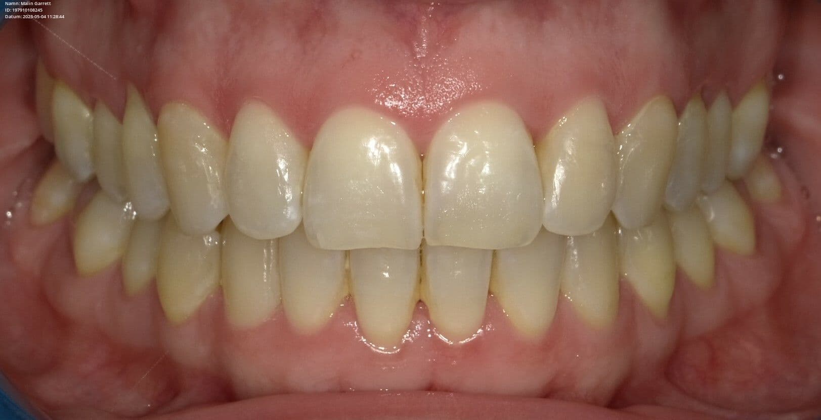 Achieving impeccable alignment without extractions