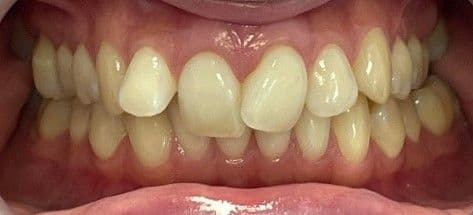 Unveiling a happier smile with Invisalign