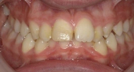 Transforming an open bite with tailored treatment