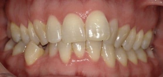 Achieving impeccable alignment without extractions